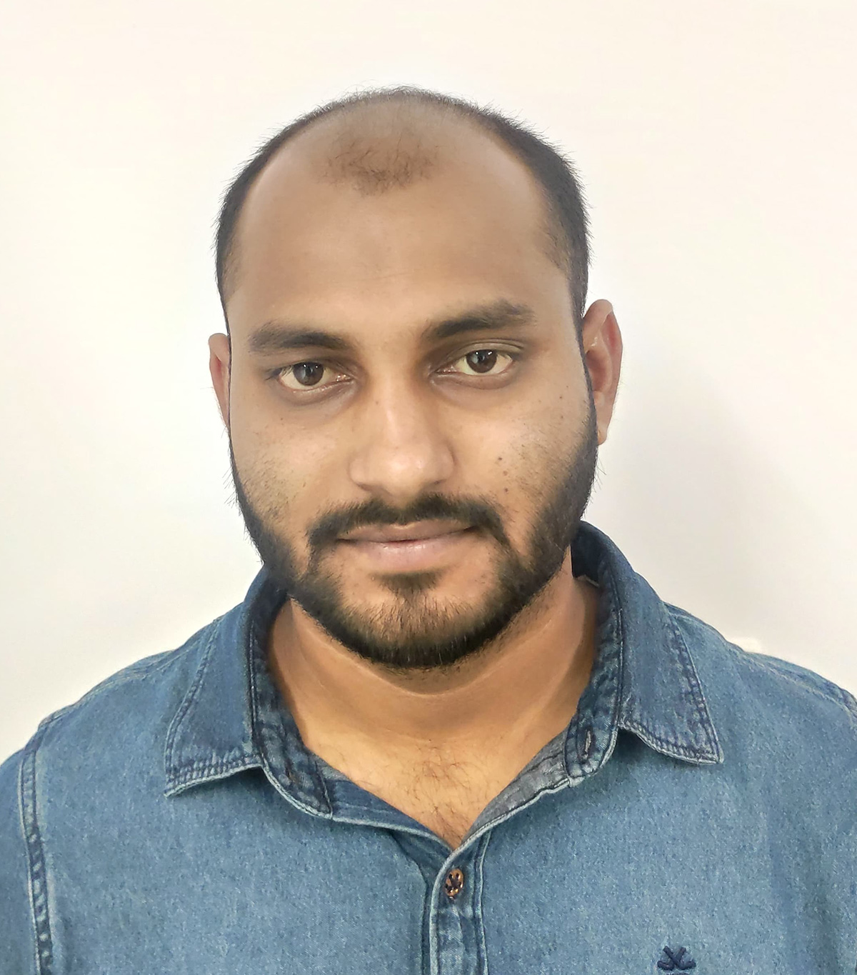 Hair-transplant-1-a Hair-transplant-1-a