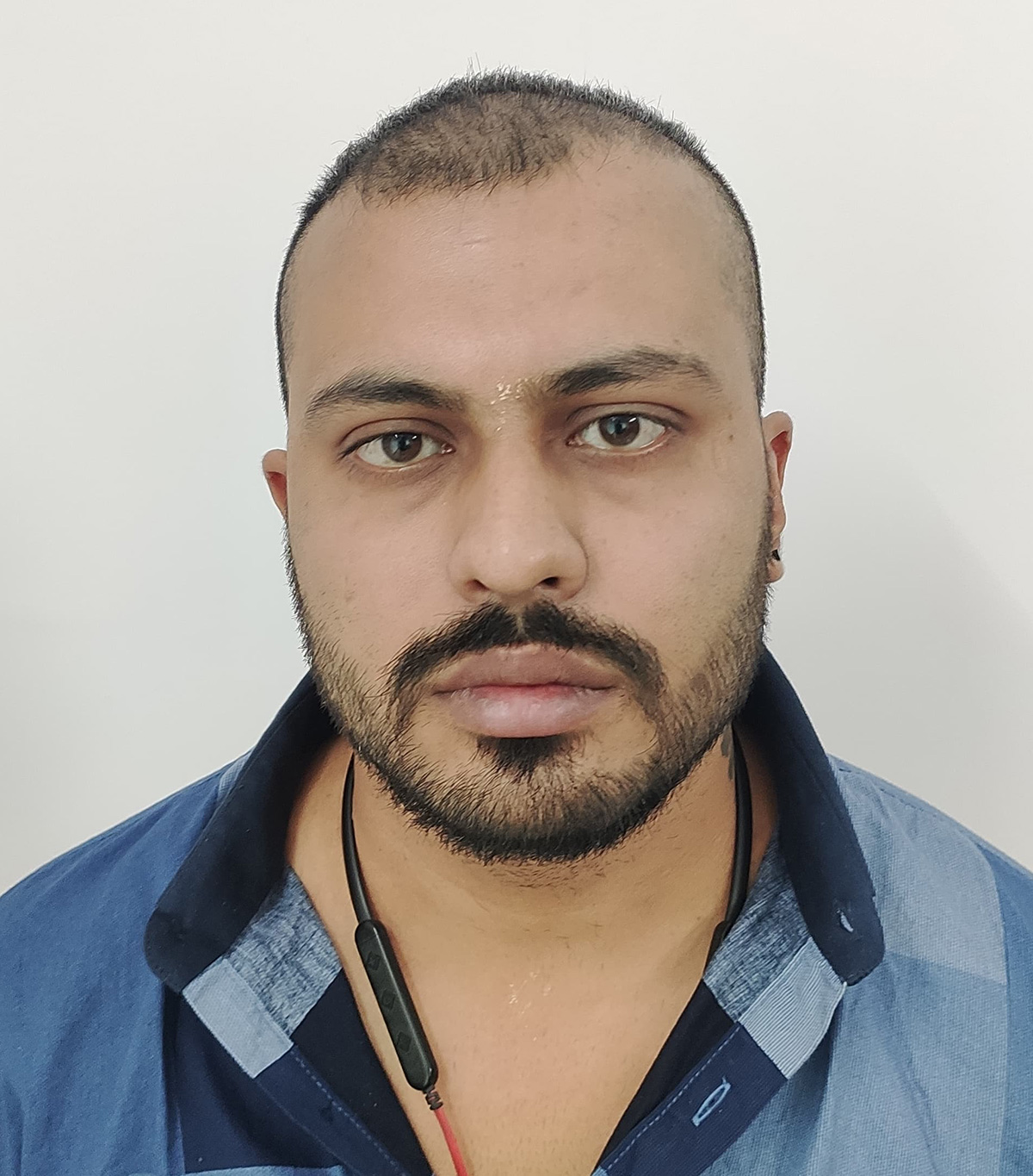 Hair-transplant-2-a Hair-transplant-2-a