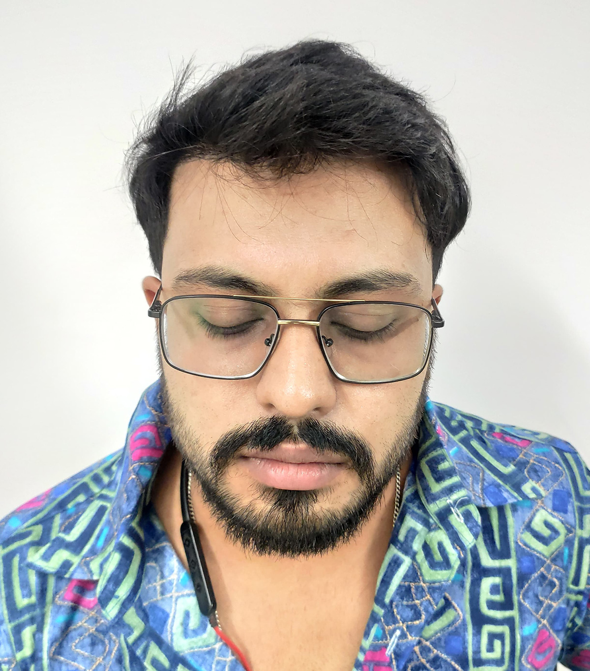 Hair-transplant-2-b Hair-transplant-2-b