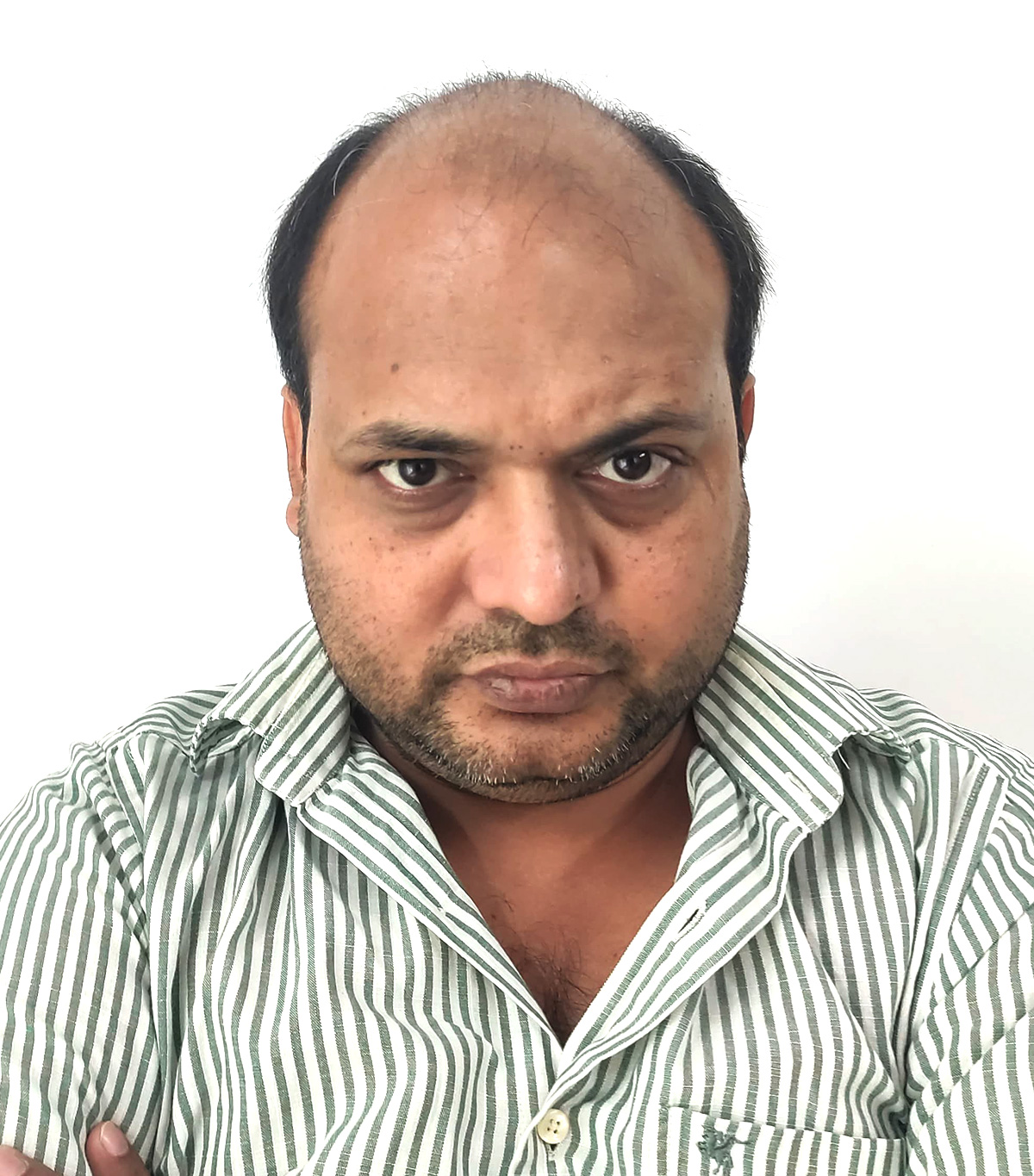 Hair-transplant-3-a Hair-transplant-3-a