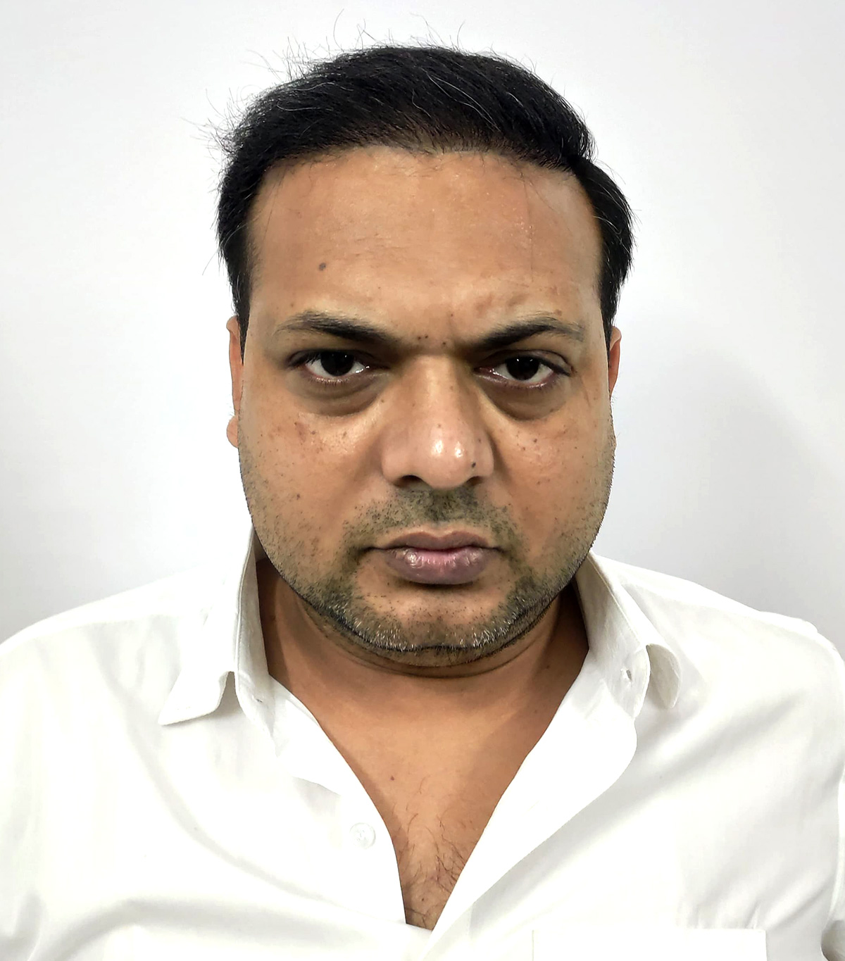 Hair-transplant-3-b Hair-transplant-3-b