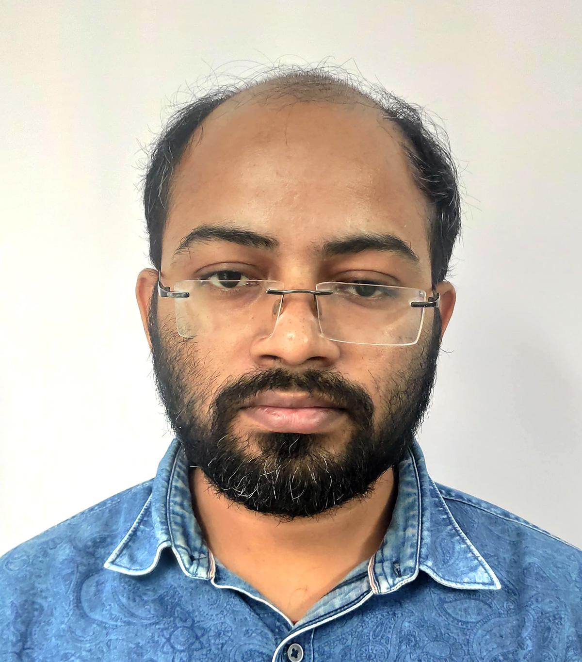 Hair-transplant-4-a Hair-transplant-4-a