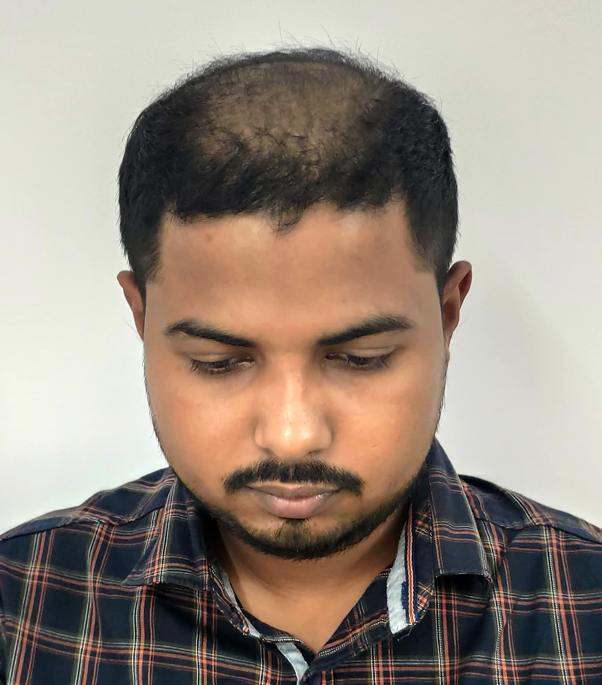Hair-transplant-5-a Hair-transplant-5-a