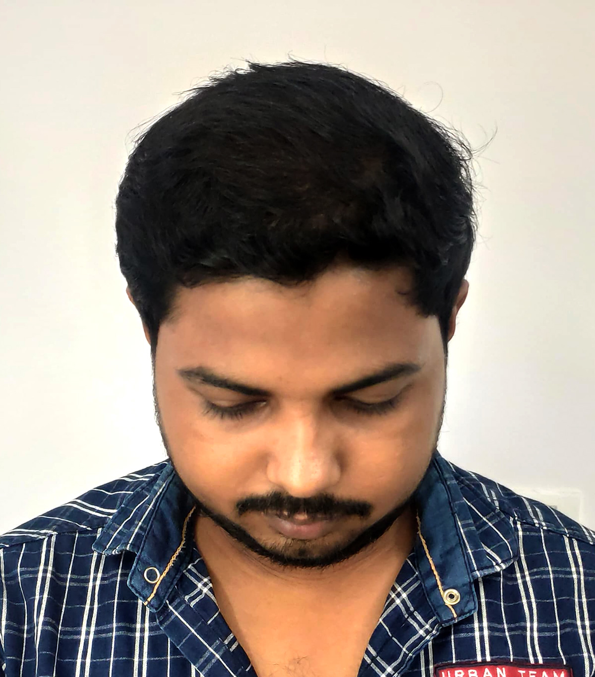 Hair-transplant-5-b Hair-transplant-5-b