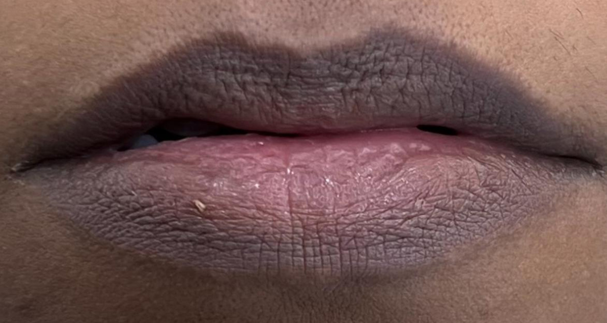 Lip-1-a Lip-1-a