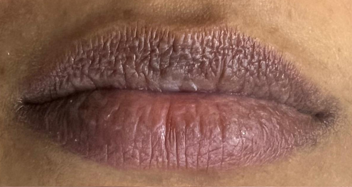 Lip-2-a Lip-2-a
